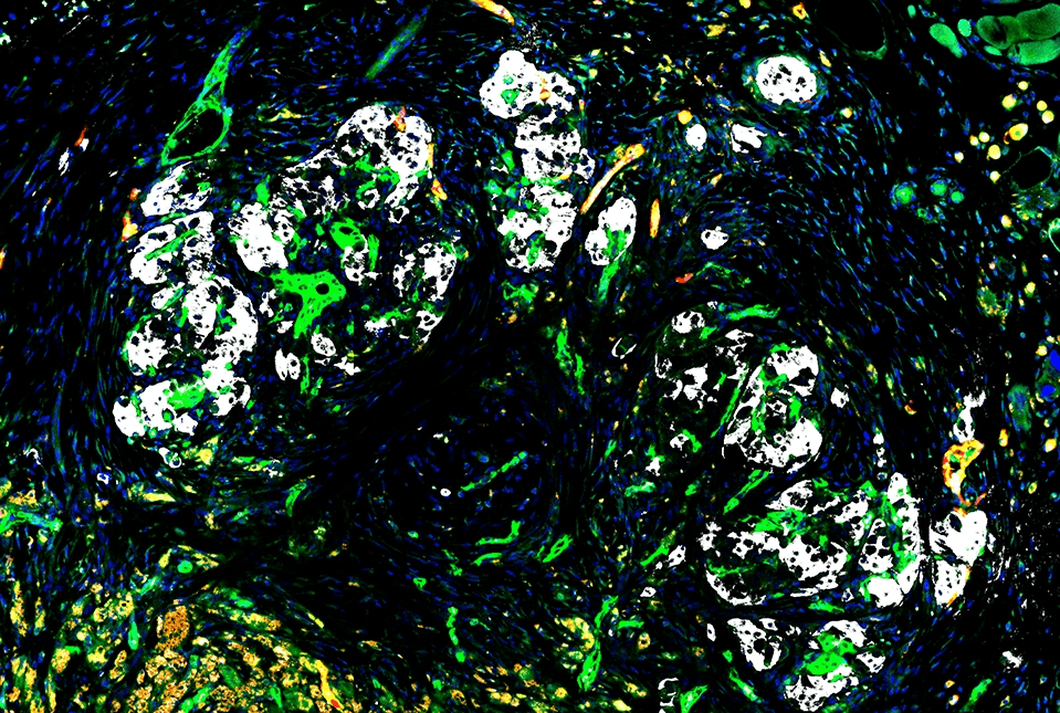 Islet Transplantation: A New Hope For Type 1 Diabetes This image displays a graft, stained to highlight its components, six weeks after transplantation of islets and reprogrammed vascular endothelial cells (R-VECs). Insulin staining reveals white islets within the graft, which are shown to be vascularized by green blood vessels originating from the transplanted R-VECs. These R-VEC-derived vessels connect with the host's red blood vessels. Image credit: Dr. Ge Li.