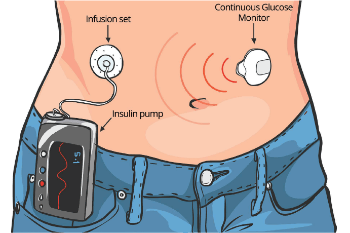Insulin Pump for Effective Diabetes Management in Healthy Living with Diabetes